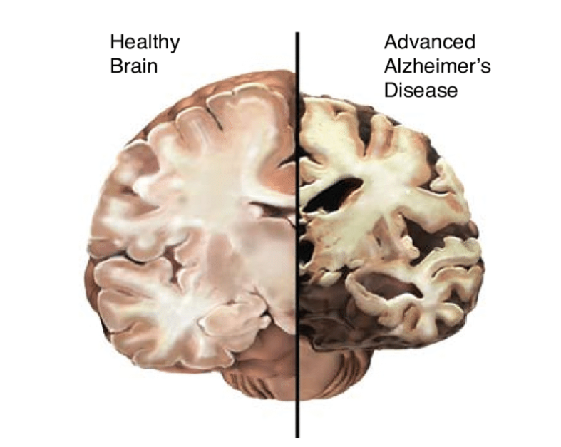 The brain of an Alzheimer's patient Compare the brain of a normal person (Source - https://www.researchgate.net/figure/The-Healthy-Brain-left-and-the-Alzheimers-Brain-right_fig1_5261932)